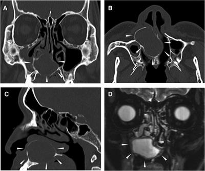 Case report: Unilateral transnasal endoscopic marsupialization of nasopalatine duct cyst